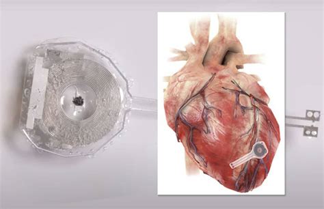 can i read a pacemaker externally using nfc|phone interferes with pacemaker.